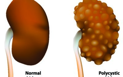 Polycystic Kidney Disease- Symptoms, Treatment & Causes