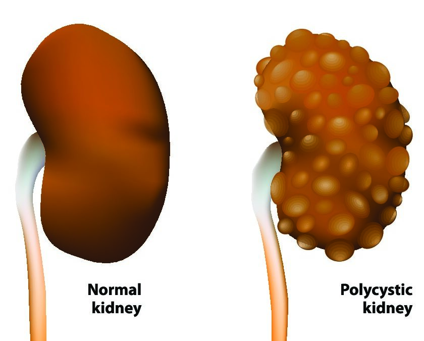 Polycystic Kidney Disease- Symptoms, Treatment & Causes