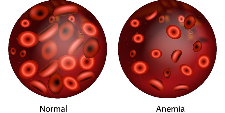 Anemia condition