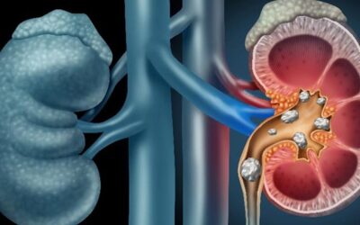 Understanding Kidney Stones and Effective Strategies for Prevention