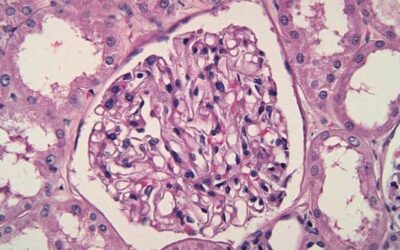 Understanding Glomerulonephritis: Causes, Symptoms, and Diagnosis