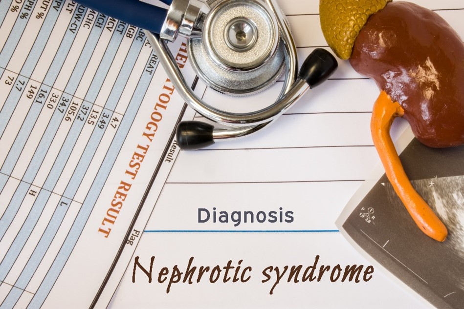 Understanding Nephrotic Syndrome: A Guide to Symptoms, Causes, and Treatment 3